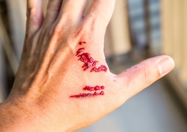 Dog Bite Accidents